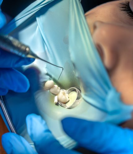 The dentist treats the child's tooth using a rubber dam. Installing a filling in a tooth. High quality photo. Visiting dentist office. Dentistry concept. Installing a rubber dam on the tooth. SSUCv3H4sIAAAAAAAAA41P0W6DMAz8Fz+DBCVslF+p+hBij1oFUiVm1YTy73Mo1V6XpztffHfegBF6IHs6ty1WJQ4VlnVNX+VwrmzpPo2hrunch0MoAK0Q9HXTdKfWVKoZ01b6ChhsZAf9BjxNa5Rghf0CvSqBFqSwQ0IWH9hOylIBUayskaKuKXPqPaq687ffZctzLajhcR0ySMU/Z9cC7EiL+8n+KReZyO5xF5XuT6EwH9lebrliho/Ajpfx6KSn+PmFFy95d08Q7+6Mx/LrjBvrNOQsWB+Tt0h4yOsws8ibBvpmev79Tin9AvnqAdSEAQAA